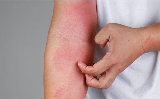 Atopic dermatitis more than skin